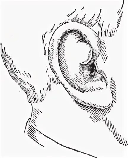 Why you should NEVER clean your ear with a cotton bud