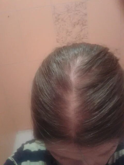 Плеш волос у девочек. Выпадают волосы у девочки 12. Залысины на голове у женщин. Выпадают волосы у девочки 12. Очаговая алопеция (alopecia areata).