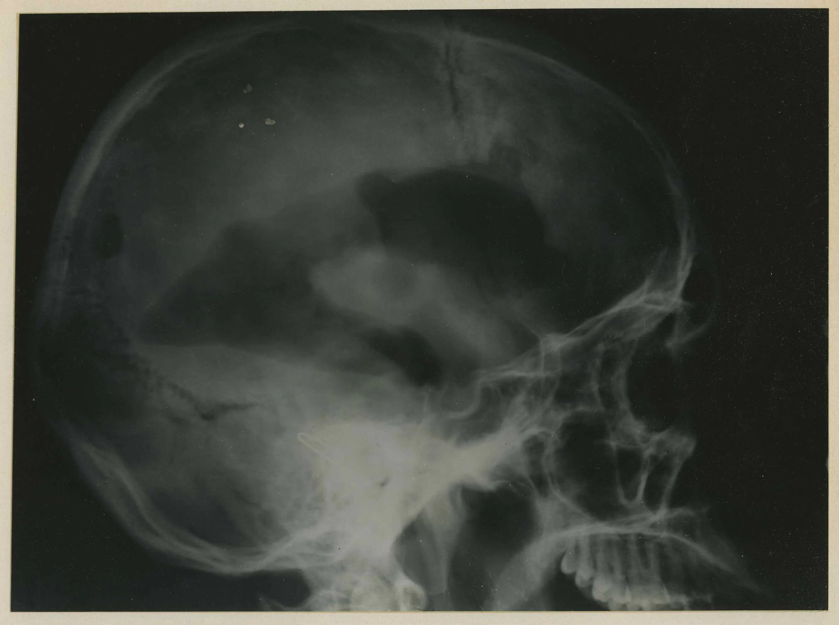 Кости черепа рентген. Перелом лобной кости рентген. Остеопороз черепа рентген. Рентгенография черепа (краниография. Трепанация черепа рентген.