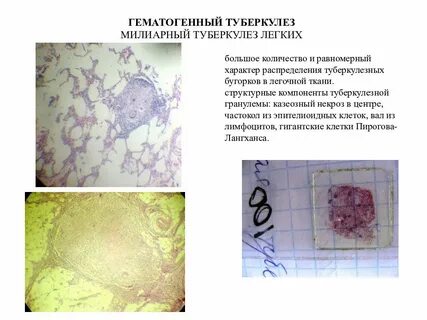 Туберкулез клетка