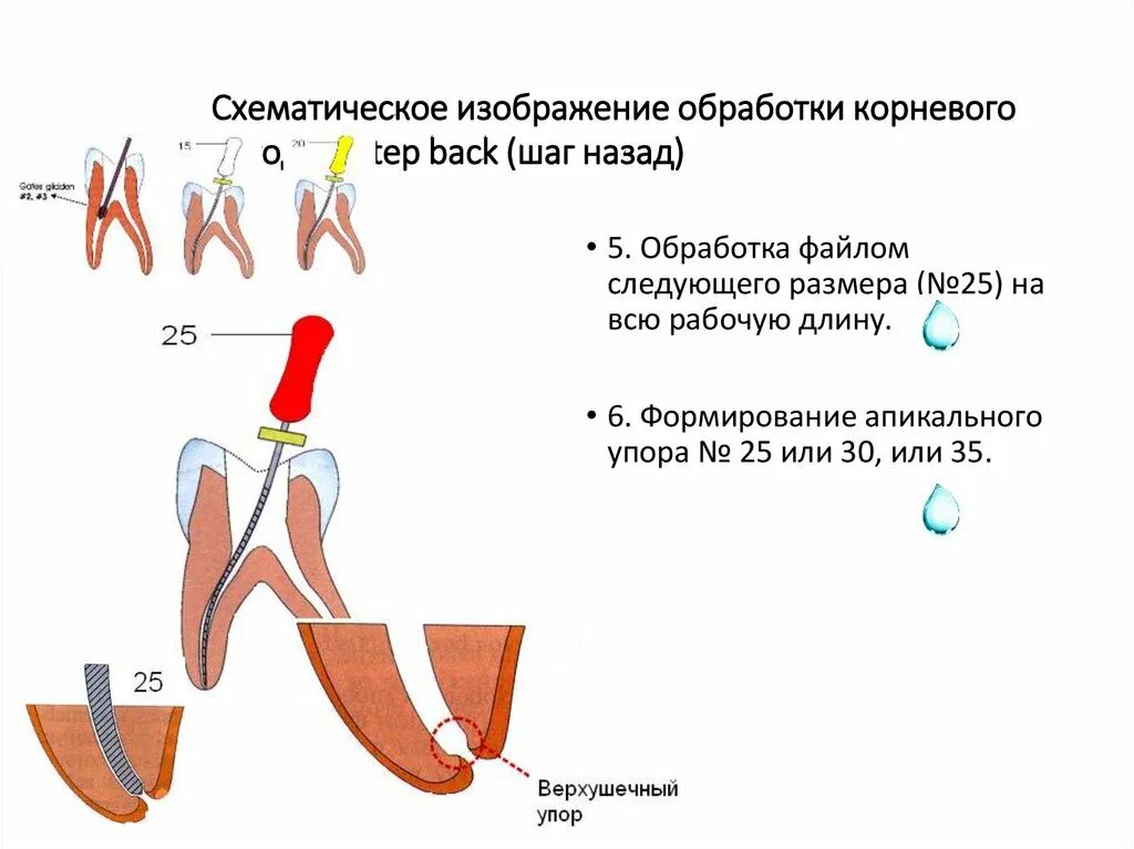 Обработка корневых каналов техники