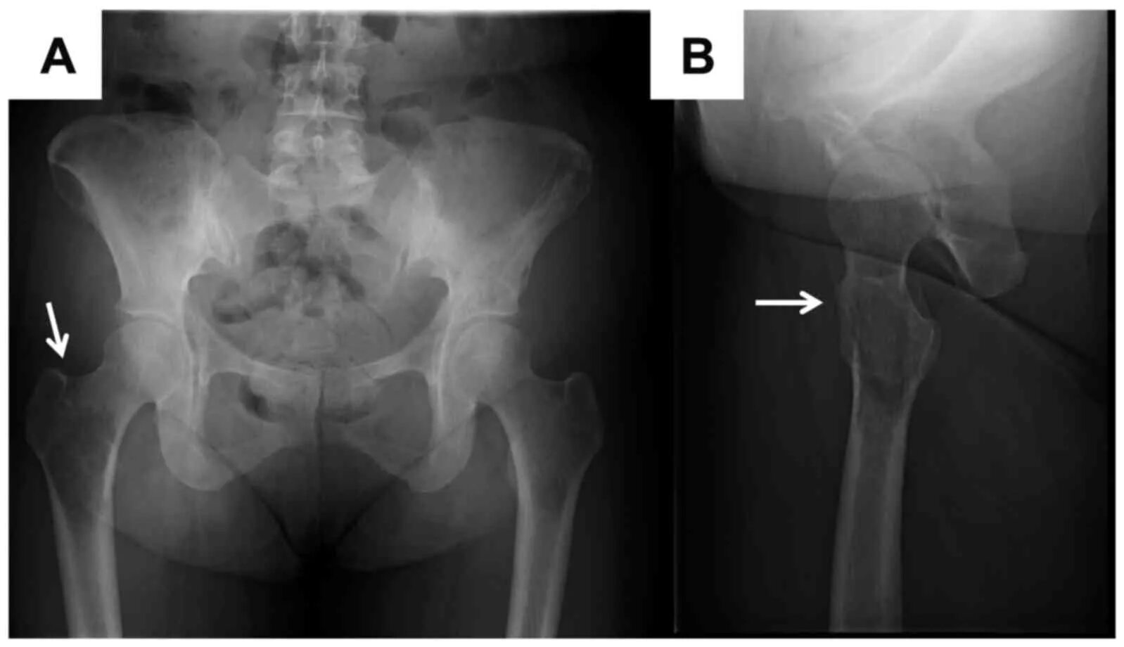 Subtrochentric Fracture of femur x ray. Trochanter Major Entesopathy чкфн.