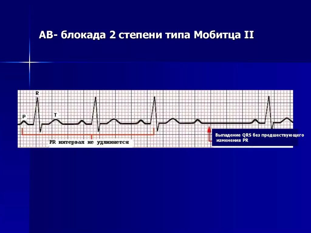 Системами блокада. АВ-блокады II степени, II типа Мобитца:. Аб блокада 2 степени на ЭКГ. АВ блокада 2 степени Мобитц 1 на ЭКГ. Атриовентрикулярная блокада 2 ст.