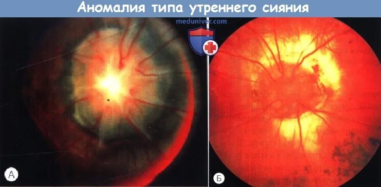 Аномалия развития зрительного нерва. Симптом «утреннего сияния» зрительного нерва. Врождённая аномалия диска зрительного нерва Вьюнок. Синдром утреннего сияния.