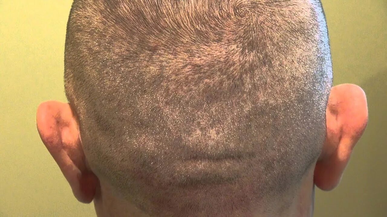 Пересадка волос донорская зона. Шрамы после пересадки волос. Пересадка волос на голове у мужчин. Донорская зона для пересадки волос.