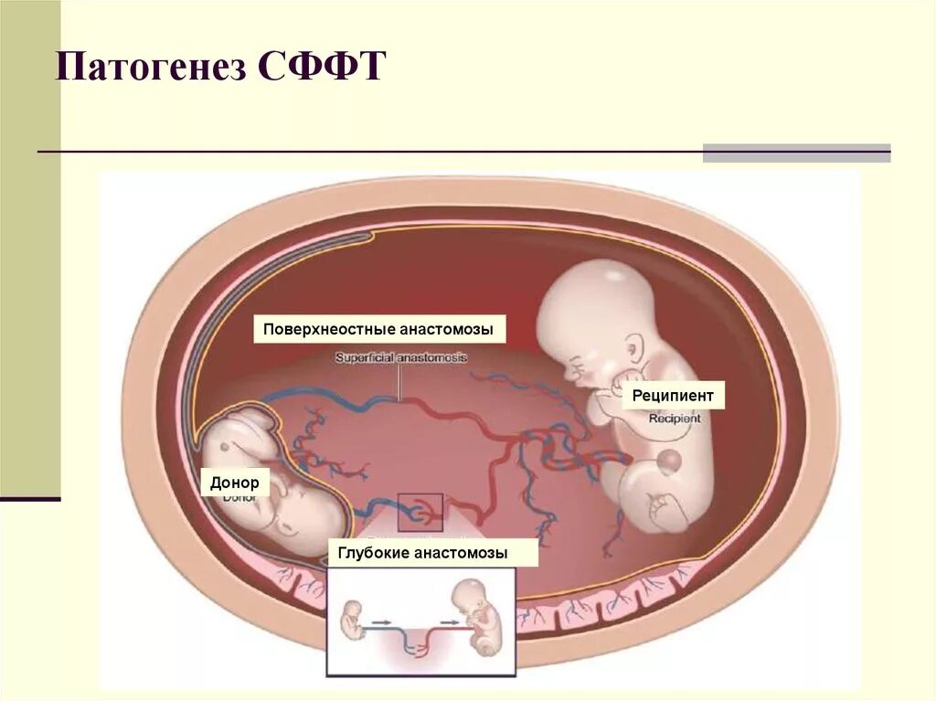 Плацента на какой неделе. Фето фетальный синдром. Фето-фетальный трансфузионный синдром УЗИ. Фитофетальный синдром. Синдром фето-фетальной трансфузии патогенез.