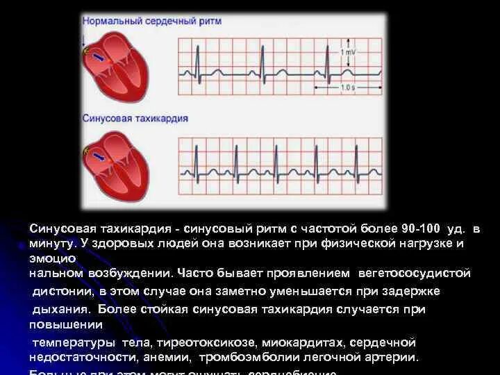 средство при синусовой тахикардии. синусовая тахикардия возникает при. чсс при ав блокаде 2 степени. причины синусовой тахик. синусовая тахикардия с чсс 110 уд/мин.