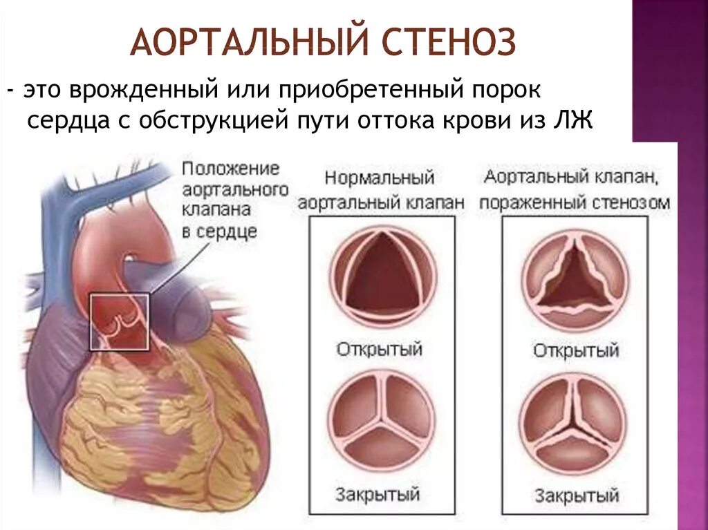 Сердечный стеноз. Порок аортального клапана. Стеноз аортального клапана. Стеноз устья аортального клапана. Порок сердца стеноз аортального клапана.