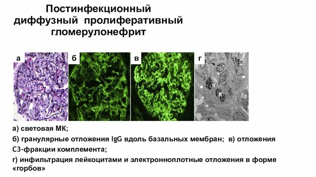 Остром диффузном гломерулонефрите