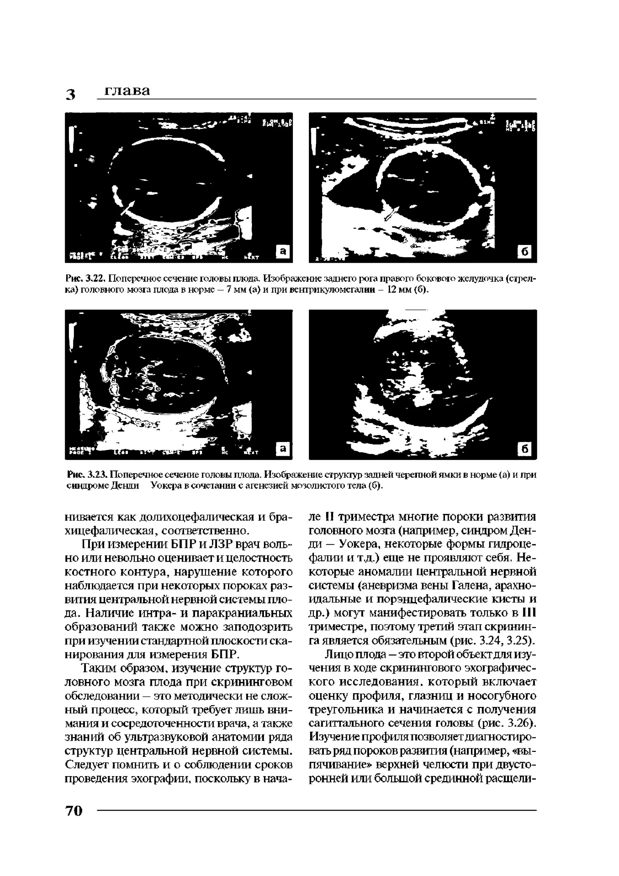 Нормы желудочков мозга у плода. Задние рога боковых желудочков плода. Вентрикуломегалия у плода норма. Тенденция к вентрикуломегалии у плода. Рост головного мозга плода.