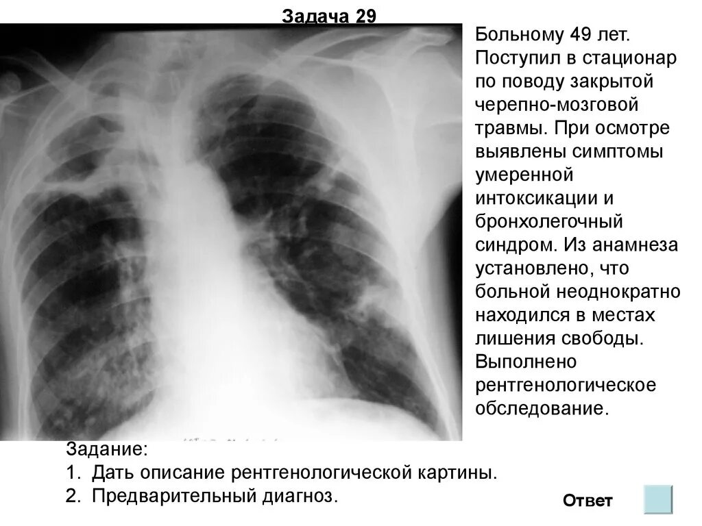 Боли в нижней доле легких. Доли правого легкого. Инфильтрация в верхней доле левого легкого. Затемнение правого легкого. Инфильтрация в нижних долях обоих легких.