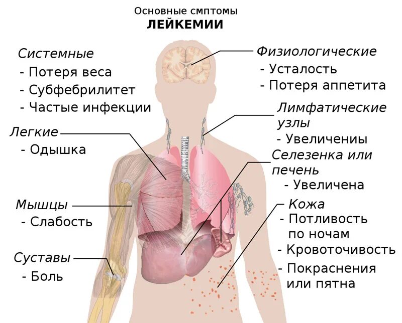 Основные симптомы лейкемии.