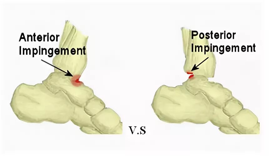 Импинджмент синдром голеностопного сустава. Задний импинджмент синдром голеностопного сустава. Импинджмент таранной кости. Таранно пяточный импиджмент.