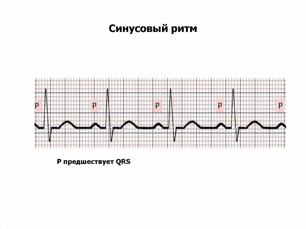 Синусовый ритм сердца у взрослого женщины. Электрокардиограмма показатели синусовый ритм. экг нормальные синусовый ритм норма. кардиограмма сердца синусовый ритм норма. норма экг синусный ритм.
