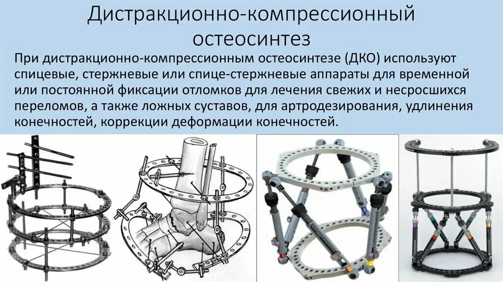 Внеочаговый компрессионно-дистракционный остеосинтез. Дистракционная остеосинтез. Дистракционная остеосинтез. Стержневые аппараты внеочагового остеосинтеза. Дистракционная остеосинтез.