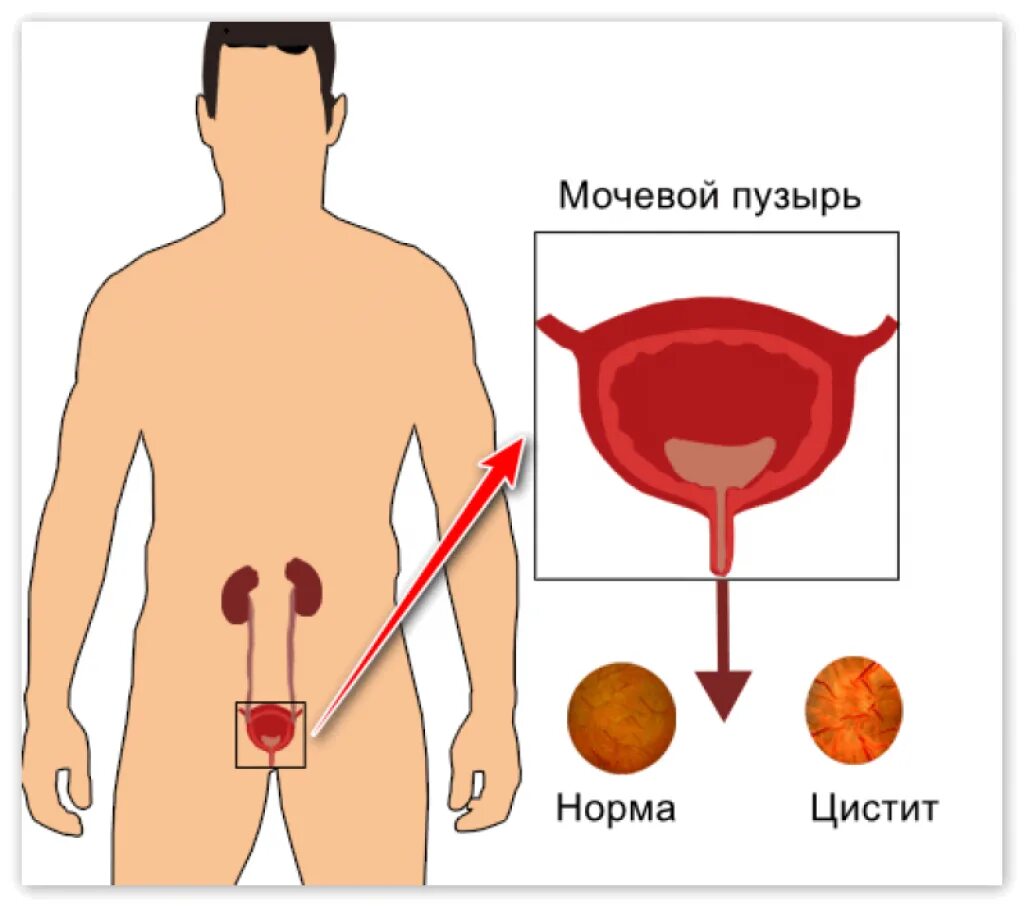 Болит полный мочевой пузырь. Воспаление мочевого пузыря у мужчин. Цистит у мужчин симптомы.