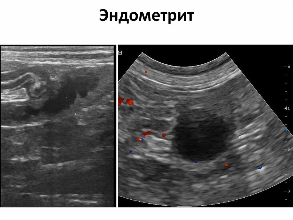 Два эндометрия. Послеродовый эндометрит УЗИ. УЗИ матки с хроническим эндометритом.