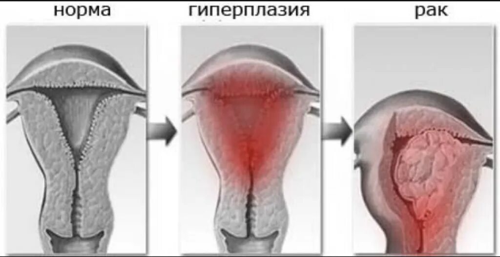 Гиперплазия матки в менопаузе чем опасно. Эндометрическая гиперплазия. Гиперплазия эндометрия эндометрит. Гиперплазия эндометрии матки. Неатипическая гиперплазия эндометрия.