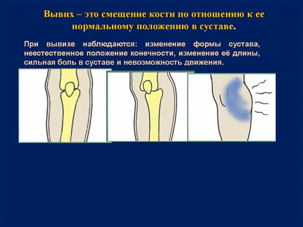 Смещение кости по отношению к ее нормальному положению. Смещение кости в суставе. Смещение костей из нормального положения в суставе. Изменение формы сустава