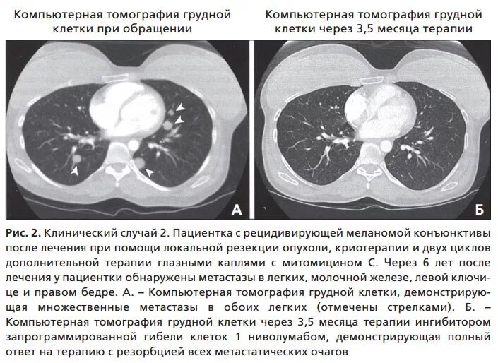 Компьютерная томография грудной клетки норма. Кт грудной клетки норма. Кт грудной клетки результат. Компьютерная томография (кт) легких.