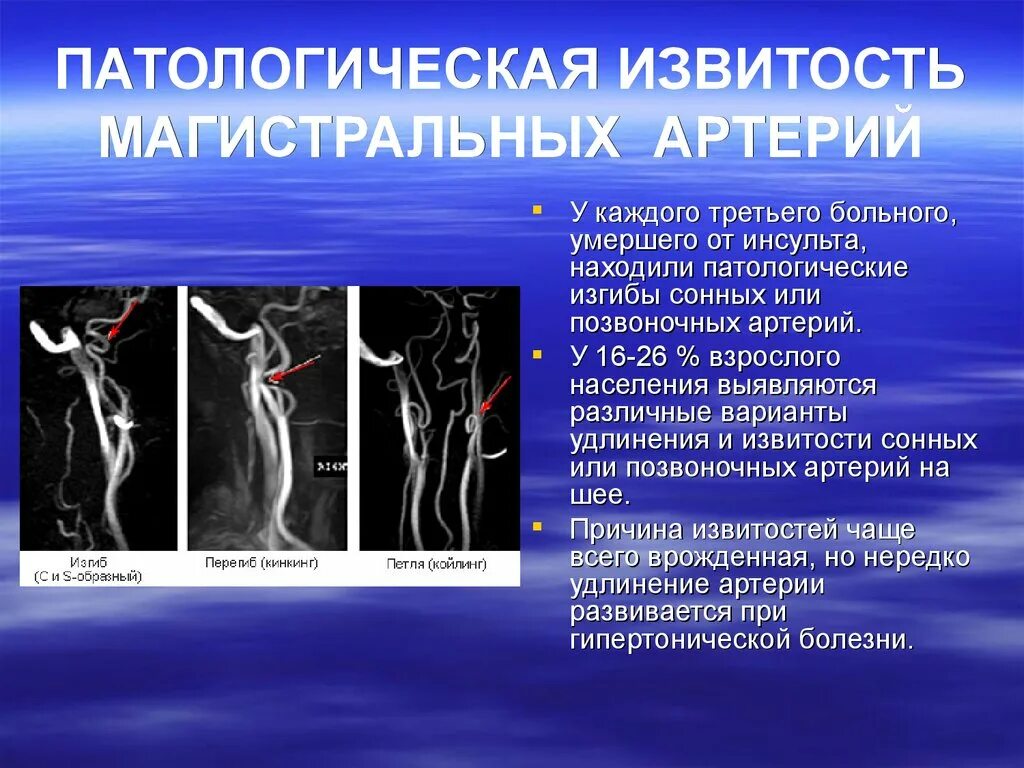 Изгиб вса. Извитость позвоночных артерий. Извитость сонных артерий кинкинг. Патологическая извитость внутренней сонной артерии. Patologichesakaia izvitost vnutrenoi sonnoi arterii.