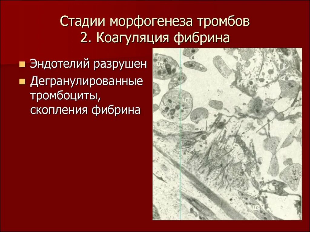 Стадии морфогенеза тромба. Стадии морфогенеза. Морфогенез тромба стадии. Морфогенез образования тромба. Тромбоциты и тромбы