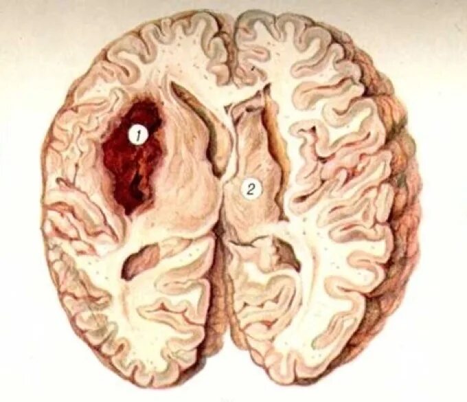 Кровоизлияние в желудочки. Геморрагический инсульт макропрепарат. Патологическая анатомия макропрепарат ишемический инсульт. Ишемический инсульт мозг макропрепарат. Ишемический инсульт препарат патанатомия.