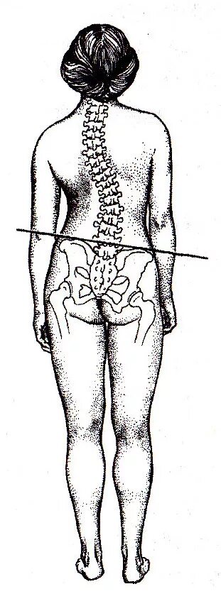 Искривление позвоночника перекос таза. Перекос таза упражнения для исправления. Исправление таза. Смещение таза. Перекос таза упражнения для исправления.