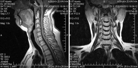 Снимок мрт норма шейный отдел. Магнитно-резонансная томография шейного отдела позвоночника. Мрт шейного отдела позвоночника. Шейный позвоночник в норме на мрт. Мрт шейного отдела позвоночника по времени