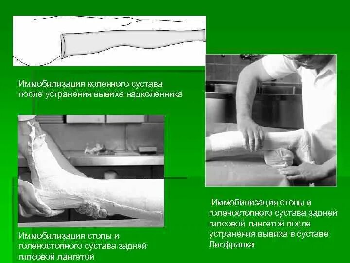 Гипсовая иммобилизация голеностопного сустава. Иммобилизация коленного сустава. Гипсовая иммобилизация коленного сустава. Иммобилизация при вывихе коленного сустава. Мобилизация коленного сустава