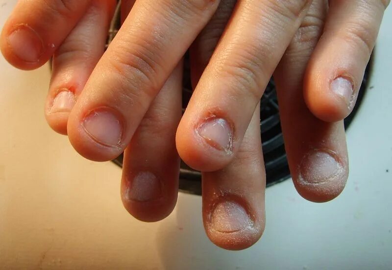 Некрасивые короткие ногти.