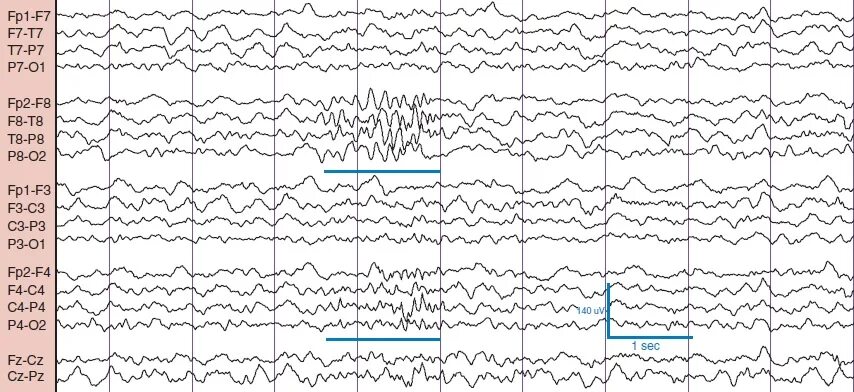 Пароксизмальная активность на ЭЭГ. Трехфазные волны на ЭЭГ. Иктальный паттерн на ЭЭГ при эпилепсии. Энцефалит на ЭЭГ. Пароксизмальная активность мозга