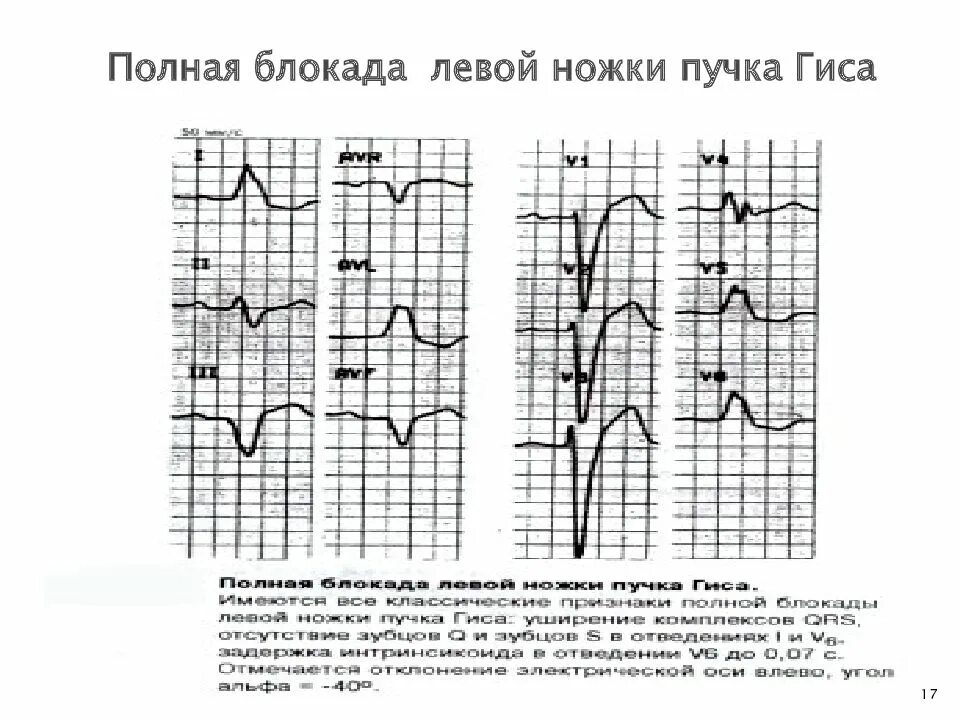 Транзиторная блокада правой ножки пучка Гиса. Блокада левой ножки пучка Гиса на ЭКГ. ЭКГ при блокаде левой ножки пучка Гиса. Блокада правой ножки и левой передней пучка Гиса. Блокада левого и правого пучка гиса