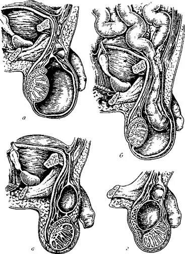 Патология половых органов. Уродство половых органов. Аномалии мужских половых органов. Недоразвитые мужские половые органы.