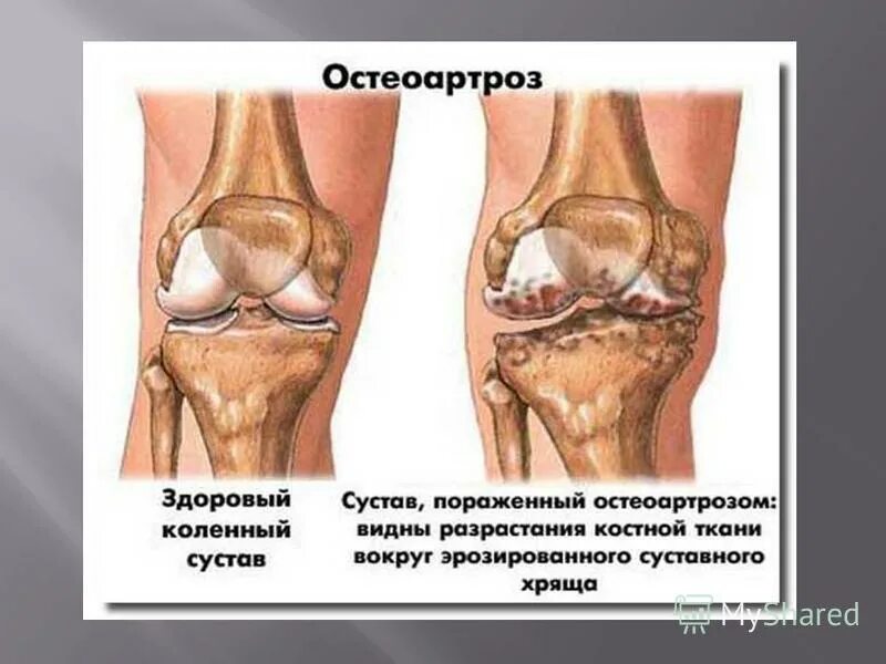 Гонартроз коленного сустава 2 и 3 степени. Субхондральный остеоартроз. гонартроз коленного сустава. деформирующий остеоартроз (доа). посттравматический деформирующий артроз.