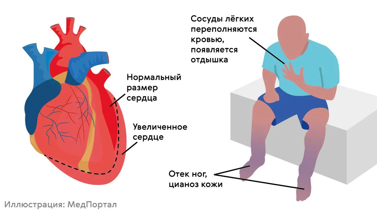 Блокада заболевание. Блокада проводящей системы сердца ЭКГ. Типы блокад сердца на ЭКГ. Блокада сердца симптомы. Проявления блокады сердца.