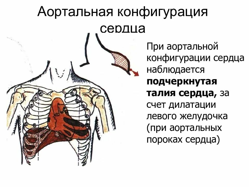 Норма форма сердца. Конфигурация сердца при аортальных пороках. Границы контуров сердца при аортальной конфигурации сердца. Талия сердца при аортальной конфигурации. Митральная и аортальная конфигурация сердца.