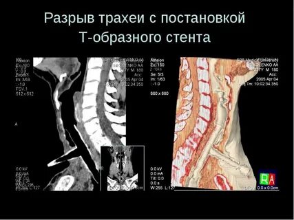 Кт трахеи