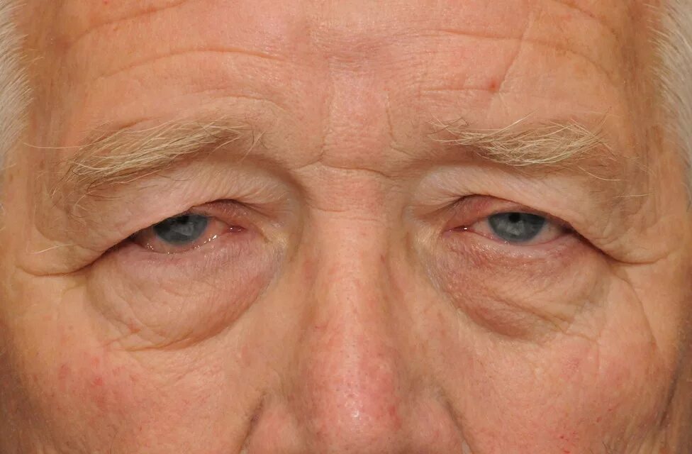 Сенильная катаракта глаза. Туберозный склероз глазное дно. Глазной склероз. Экзофтальм анизокория. Возрастная (сенильная) катаракта.