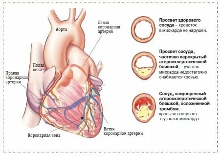Ишемическая болезнь сердца вызвана