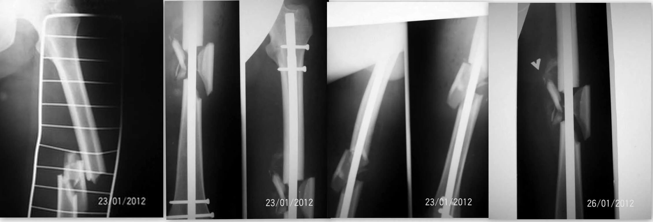 Осколочный перелом бедра. Остеосинтез бедренной кости. Оскольчатый перелом шейки бедра. Оскольчатый перелом рентген. Осколочный перелом бедра.