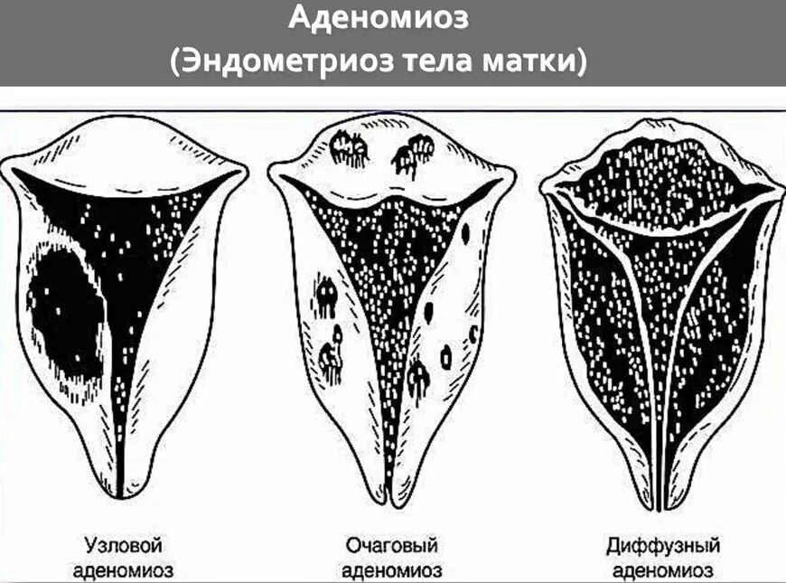 Структурные изменения матки. Аденомиоз диффузная форма. Эндометриоз матки (аденомиоз – внутренний эндометриоз). Аденомиоз очаговая форма.