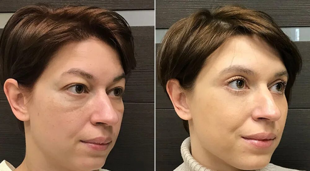 как убрать мешки на скулах