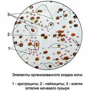 Эритроциты в моче почки