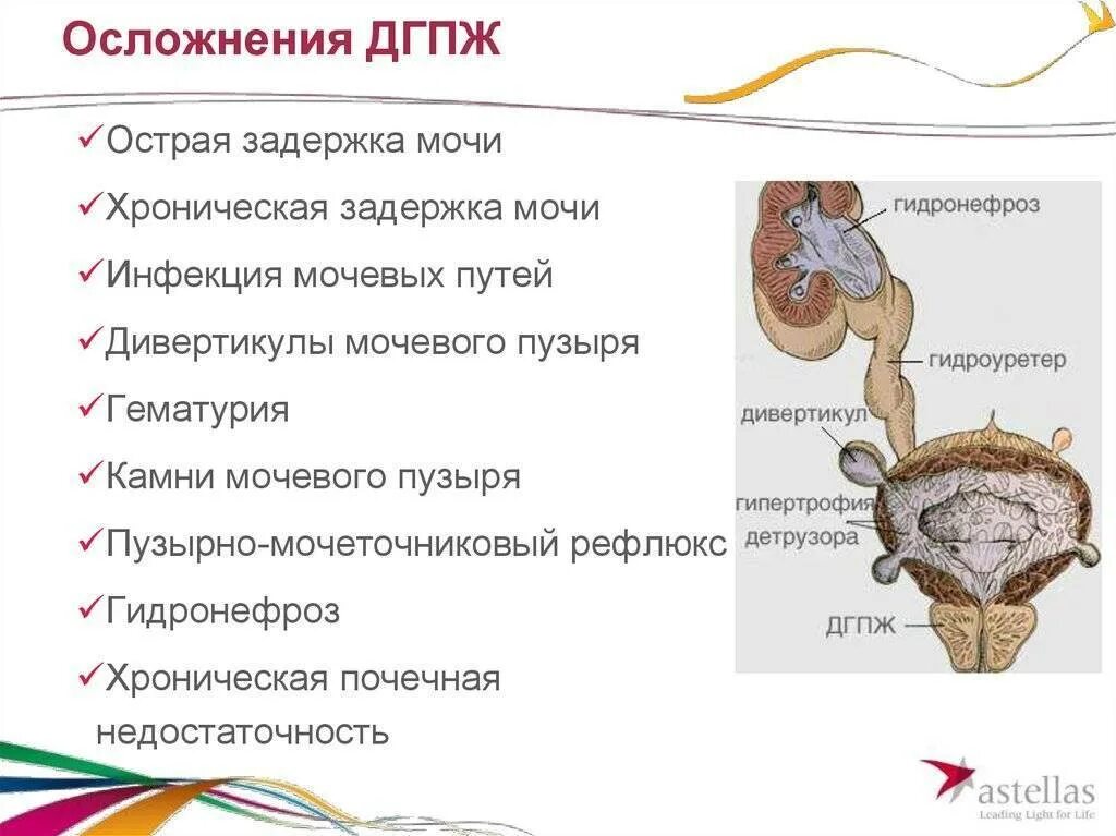 Простатит у детей. Симптомы наполнения и опорожнения мочевого пузыря. Доброкачественная гиперплазия предстательной железы осложнения. Ощущение неполного опорожнения мочевого пузыря. Осложнения гиперплазии предстательной железы.