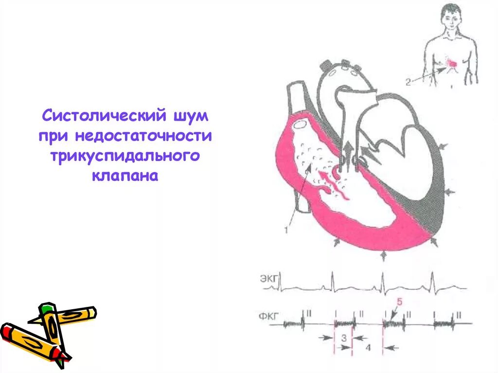 Недостаточность трикуспидального клапана систолический шум. Систолический шум при недостаточности трикуспидального клапана. Шум при недостаточности трехстворчатого клапана. Систолический шум при недостаточности трехстворчатого клапана. Систолический шум это