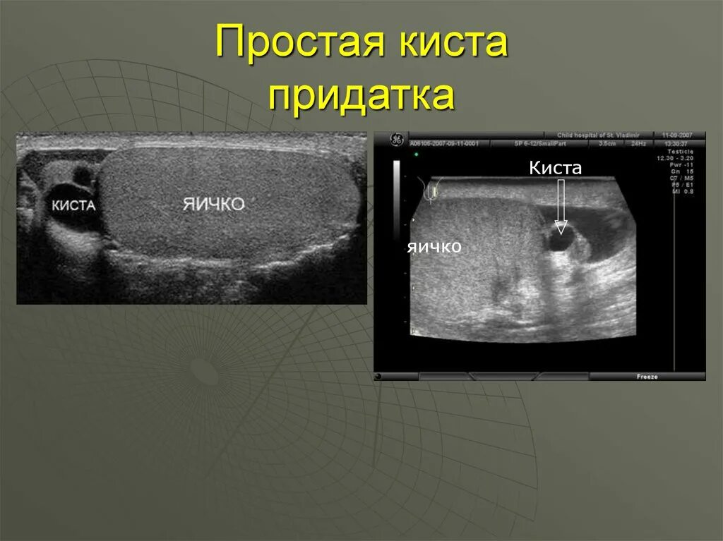 Образование придатка яичка. Киста придатка яичка на УЗИ. УЗИ мошонки киста придатка.