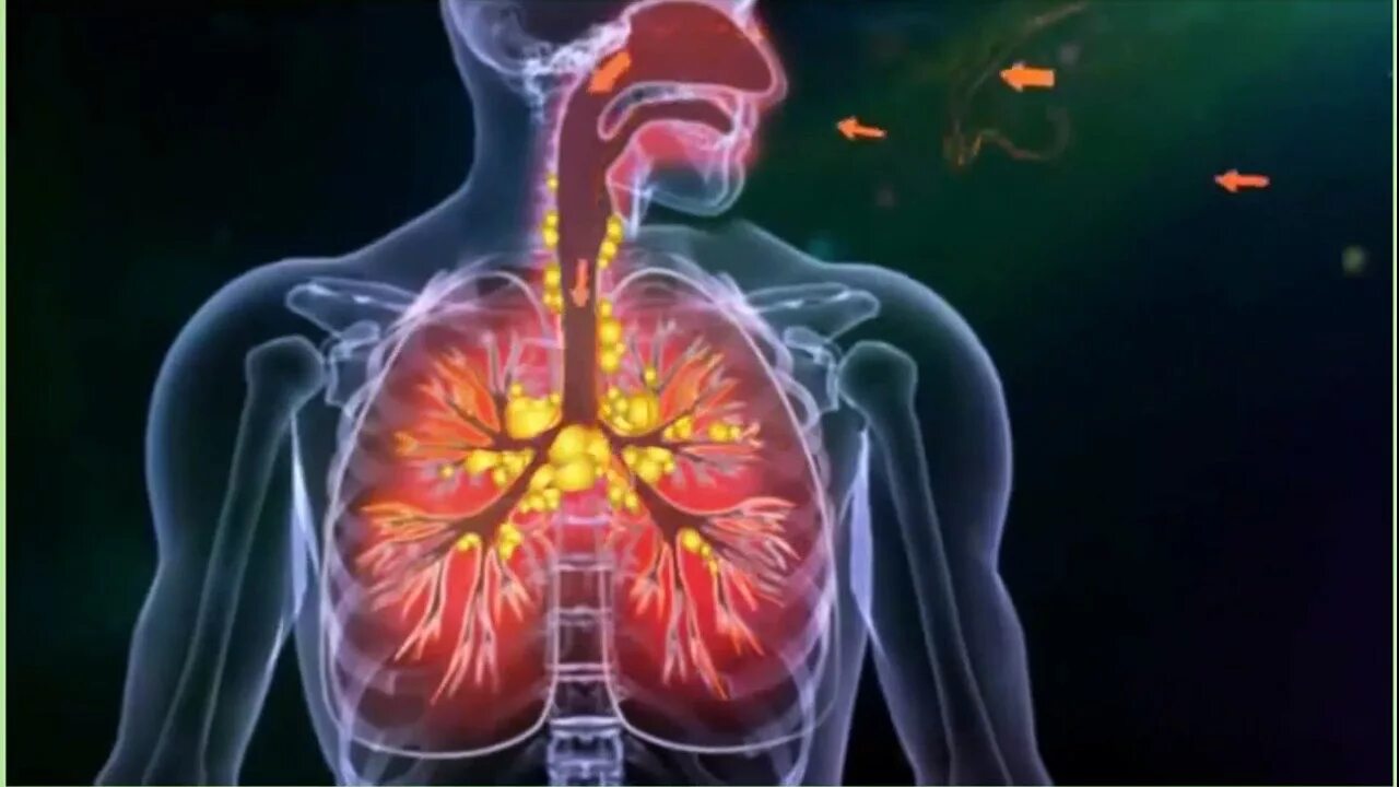 Открытая форма туберкулеза. Туберкулез картинки фото. Туберкулез tuberculosis