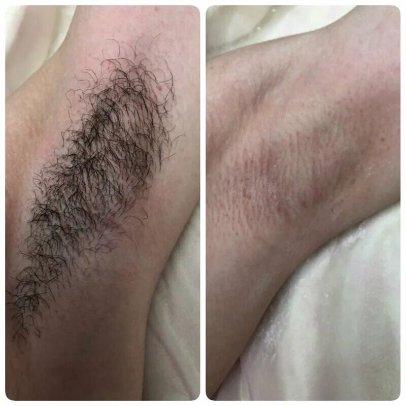 депиляция для мужчин. волосы после лазерной эпиляции. мужские зоны для лазерной эпиляции. зоны мужской эпиляции. мужская эпиляция.