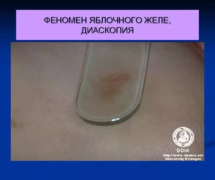 Диаскопия пальпация поскабливание элементов. Метод масляной витропрессии. Методика проведения диаскопии. Кожные аллергические пробы имеют значение для уточнения диагноза. Симптомы туберкулезной волчанки.